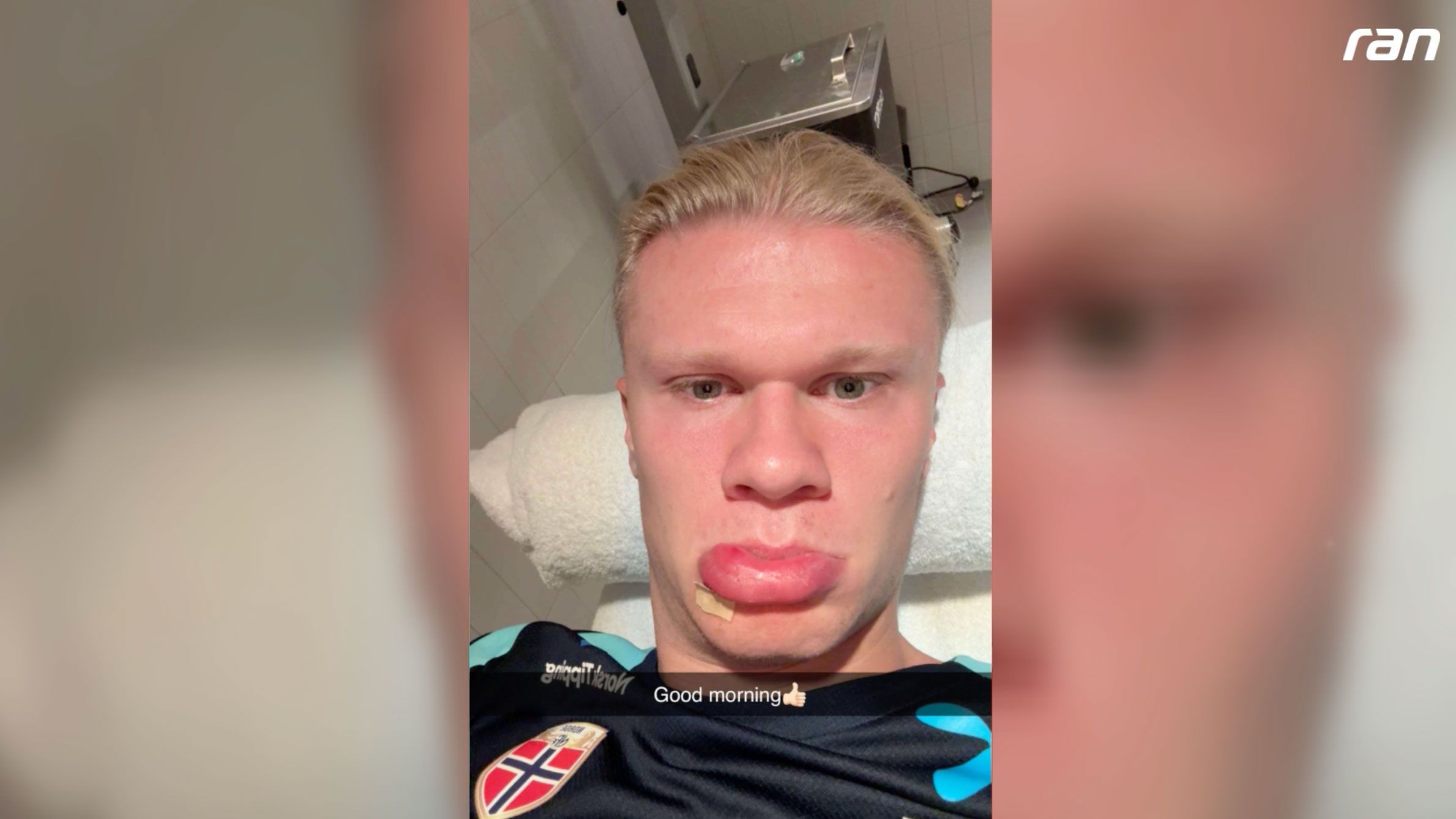 Erling Haaland: Dicke Lippe riskiert? Superstar postet kuriose Verletzung