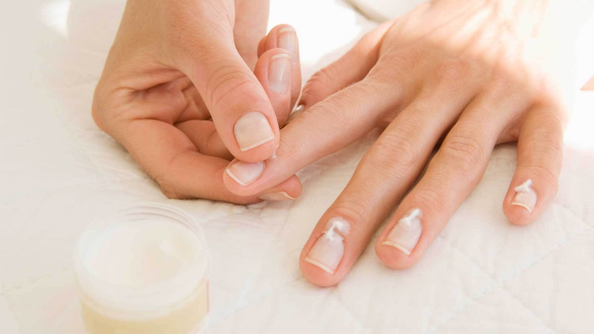 Cracked cuticles? Here come 3 lightning tips against the finger cracks