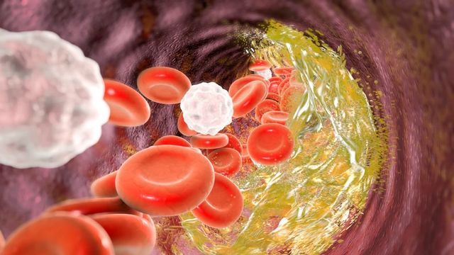 Wie Sie Ihren Cholesterinspiegel senken – und wann ein Check beim Arzt sinnvoll ist