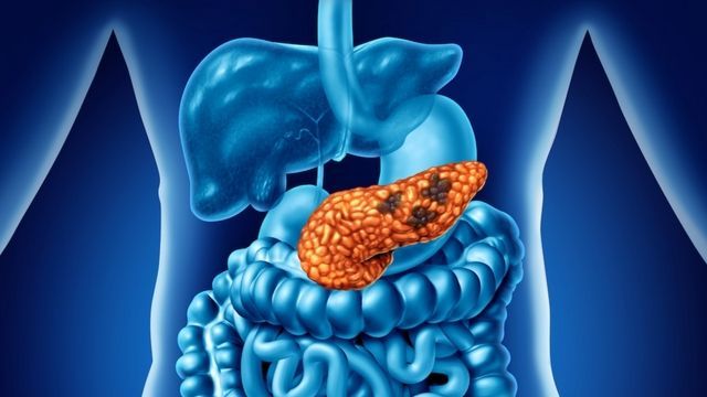 Gefahr Bauchspeicheldrüsenkrebs: Diese 10 Warnzeichen sollten Sie kennen