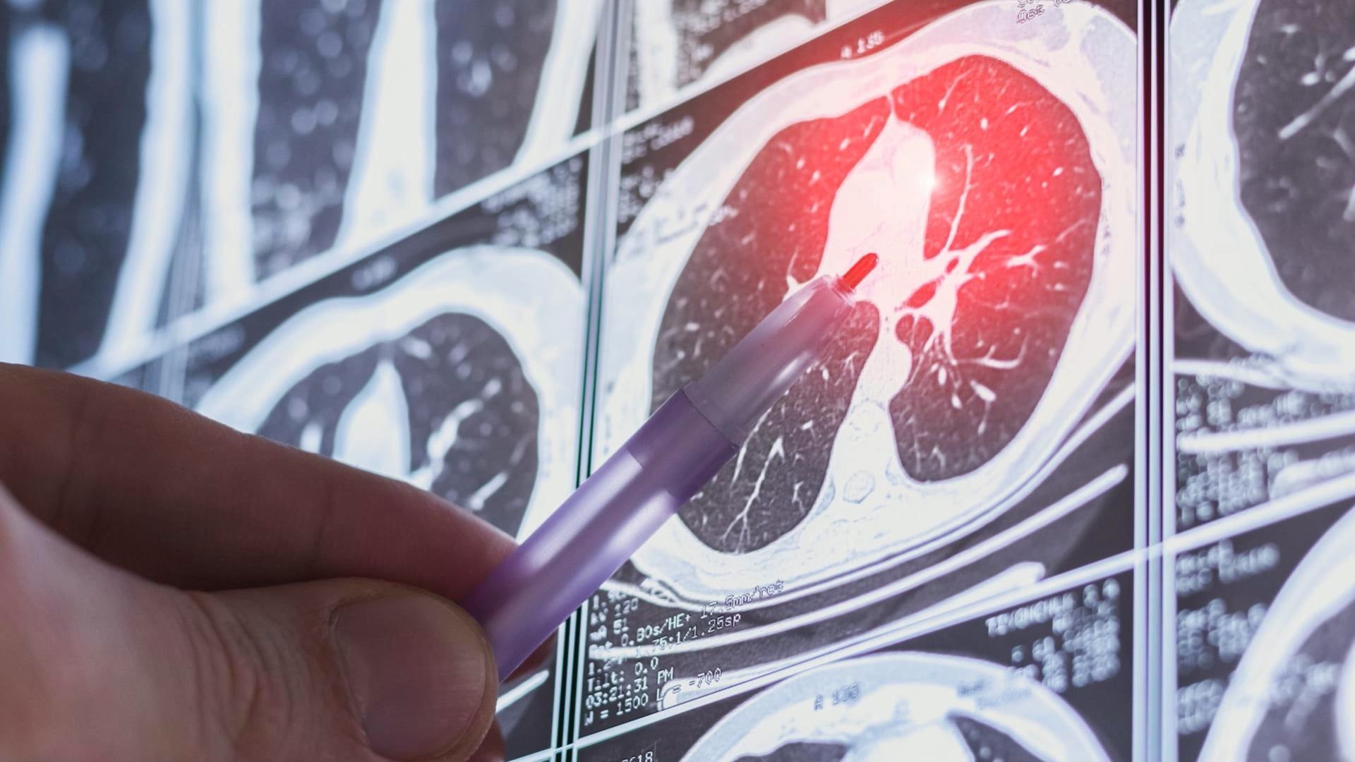 How to Recognize Early Signs of Lung Cancer