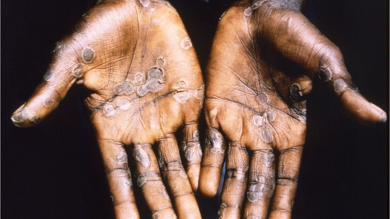 Notfallausschuss einberufen: Gefährliche Mpox-Variante breitet sich rasant aus - Video